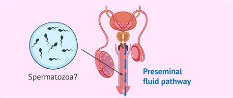 Spermatozoa In Preseminal Fluid
