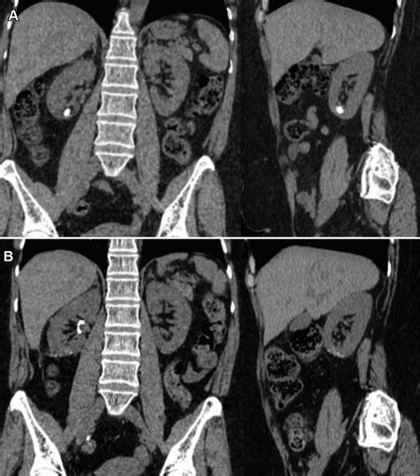 Ct Image Of The Anteriorly Located Caliceal Diverticular Calculus