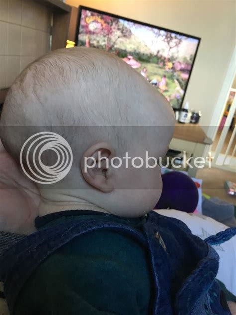 Baby With Big Back Of Headlump Sort Of On Head Babycentre