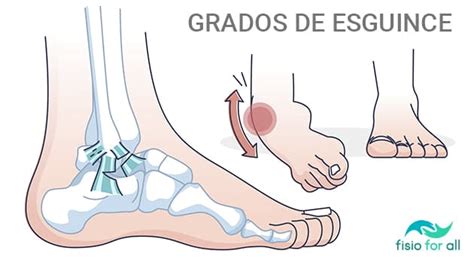 Esguince De Tobillo Grados Síntomas Y Tratamiento