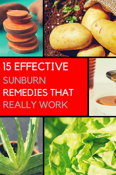 15 Ultra Relieving Sunburn Remedies That Really Work
