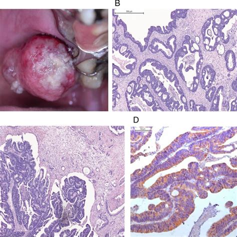 Clinical And Histological Findings A Initial Clinical Photograph