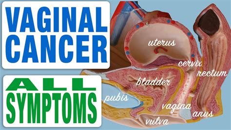 Vaginal Cancer All Symptoms Youtube