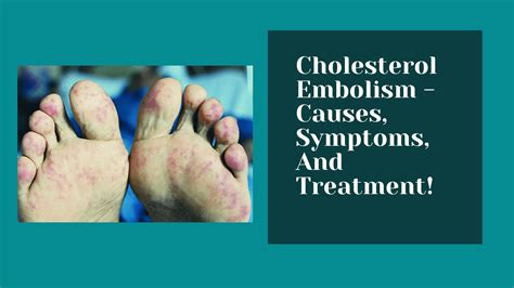 Cholesterol Embolism Causes Symptoms And Treatment