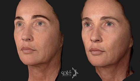 Dermal Fillers Before And After Pictures Case 85 Tifton Ga Solé