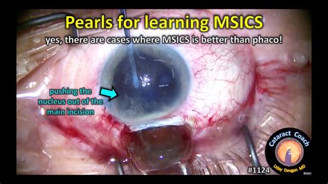Cataractcoach 1124 Pearls For Learning Msics Manual Small Incision