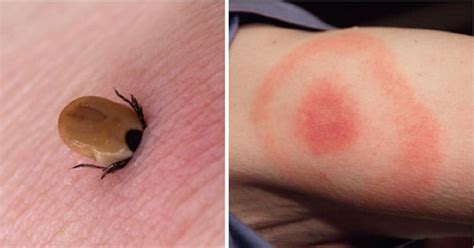 Lyme Disease How You Can Protect Yourself And Prevent An Infection