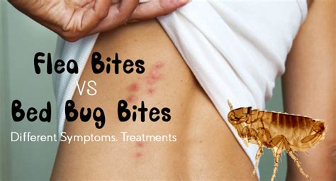 Flea Bites Vs Bed Bug Bites Different Symptoms Treatments Allergy