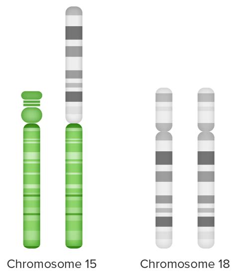 Edwards Syndrome Trisomy 18 Concise Medical Knowledge