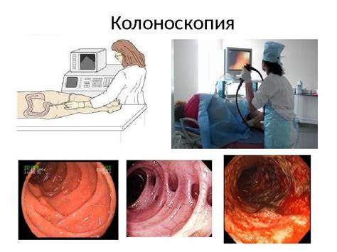 Полип толстой кишки диета Гиперпластический полип толстой кишки: что это такое Гиперпластический полип толстой кишки: что это такое Полип толстой кишки диета