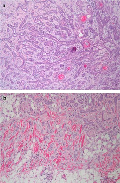 Microcystic Adnexal Carcinoma An Immunohistochemical Reappraisal