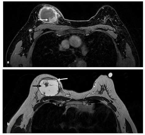 A Axial T1 Post Contrast Mri Showing A 50 Mm Cystic Mass With A Solid