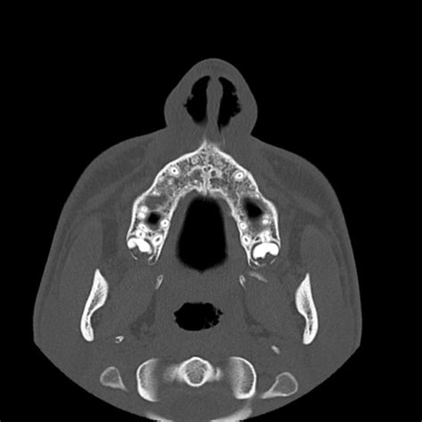 They are placed side by side at the middle and upper part of the face and by their junction, form the bridge of the nose. Nasal bone fracture | Radiology Case | Radiopaedia.org