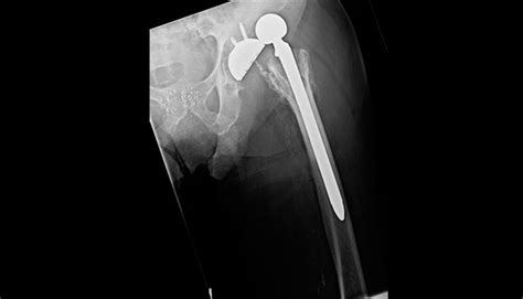 Total Hip Replacement Dislocation