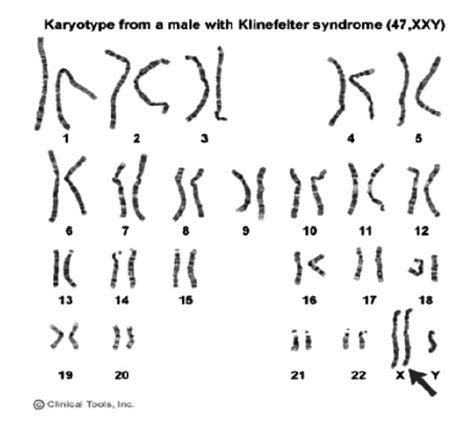 Example Of Sex Chromosome Disorders Turner S Syndrome Klinefelter S