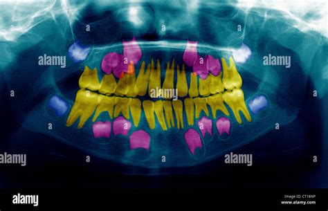 Child Tooth X Ray Stock Photo Alamy