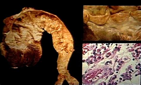 The most common route of transmission is through contact with an infected person's sore during sexual activity. Syphilis, Cardiovascular; Aortitis, Syphilitic ...