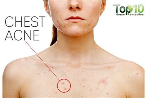 Chest Acne Causes And 5 Ways To Get Rid Of It Emedihealth