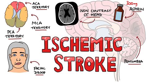Acute Ischemic Stroke Signs And Symptoms Stroke Syndromes Causes