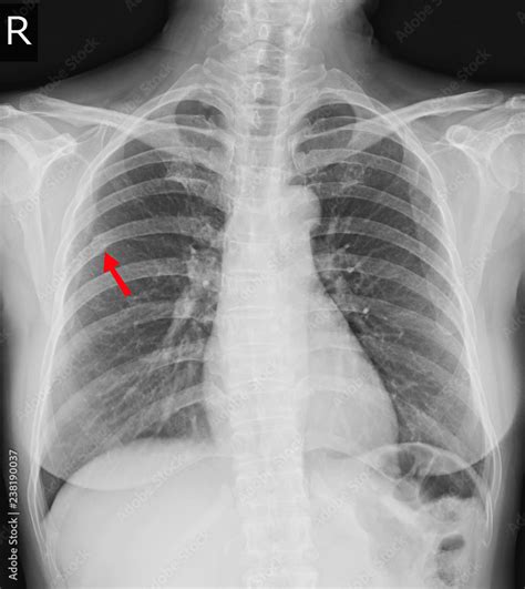 Chest X Ray Fracture Right Posterior Th Rib And Possible Fracture Lateral Aspect Of Left Th