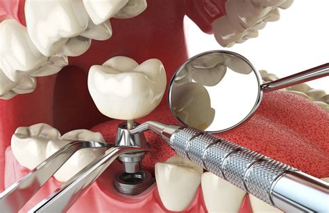 Dental Implants Procedure Dr Paulo Pinho