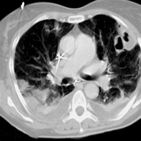 High Resolution Computed Tomography Of The Thorax Showing Cavitation