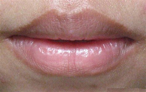 Infection On Lips Pictures Photos