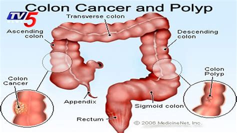Colon Cancer Causes Symptoms And Treatments Omega Hospitals