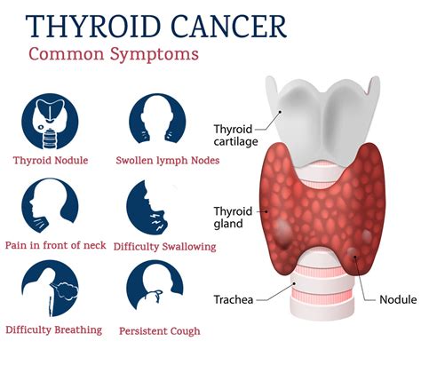 Thyroid Cancer Symptoms Tampaexplorer