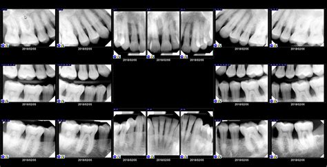 Dental X Rays Why Which When Digital X Rays Charlotte Dentist