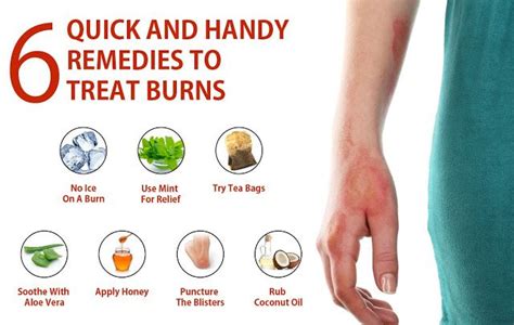 Home Remedies To Treat Burns Dafcuk Treat Burns Remedies Home Remedies