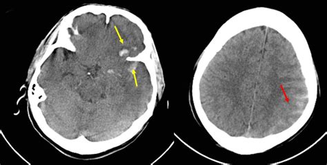 Traumatic Contusion And Subarachnoid Hemorrhage Radiology Cases