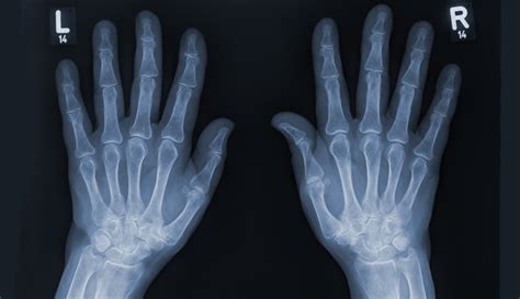 Hand X Ray Anatomy Procedure And What To Expect