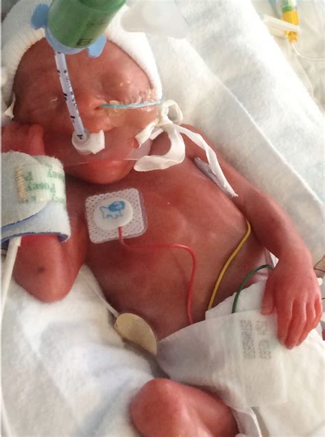 During the us in the 10 and a half week of pregnancy, you can already see the fetus, which is already similar to a in the early stages of pregnancy every third mother may experience recurrent bleeding. Baby born 15 weeks early is the same size as a PINT GLASS ...