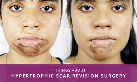 All That You Wanted To Know About Hypertrophic Scar Revision Surgery
