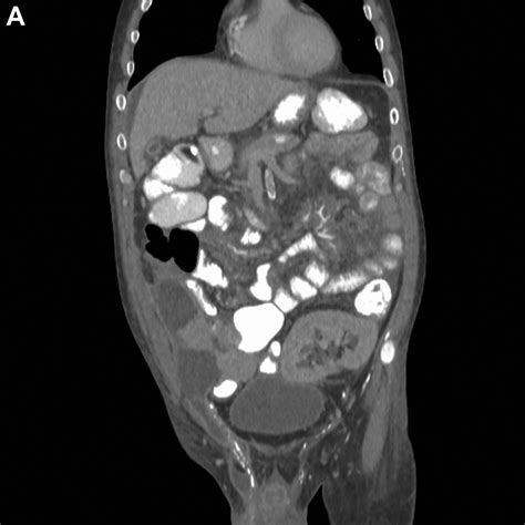 Unilateral Scrotal Swelling After Acute Pancreatitis Of Pancreas