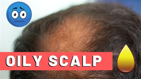 Oily Scalp Treatment For Hair Loss The Best Way Youtube