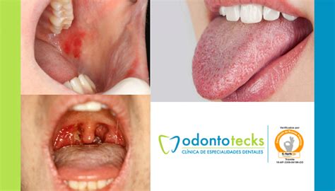 ¿boca Seca Causas Y Síntomas Odontotecks