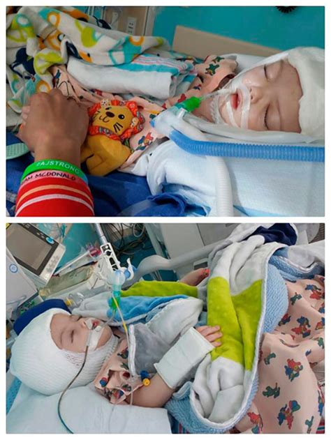 13 Month Old Twins Jadon And Anias Mcdonald Were Successfully Separated