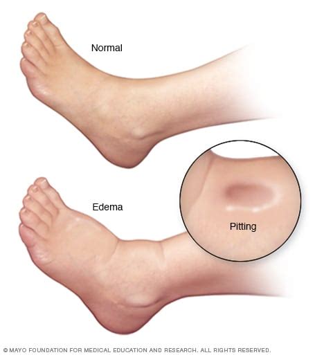 Edema Symptoms And Causes Mayo Clinic