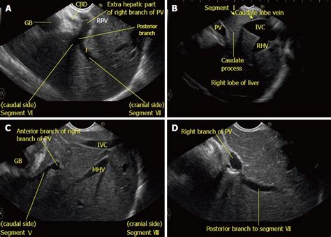 Liver Ultrasound Anatomy