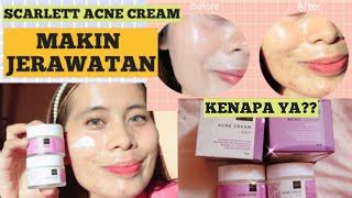 Jual Paket Scarlett Whitening Acne Serum Day Night Cream Original Di