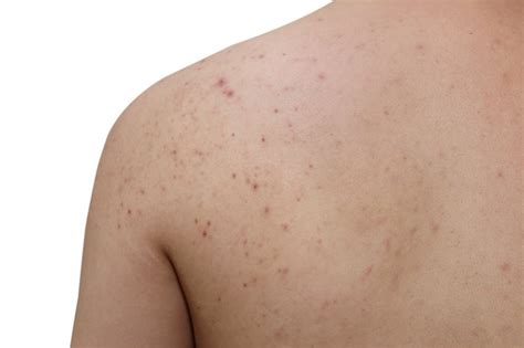 Causes Of Acne On The Arms And Back Acne Skin