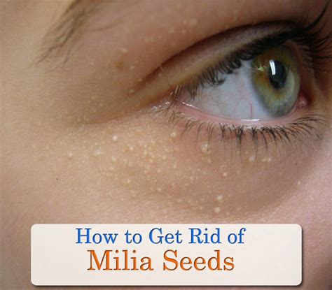 Milia Treatment Natural Ways To Remove Milia And Create Better Skin