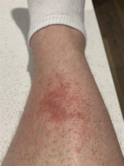 Any Idea What This Rash Is Could It Be From Exposure To Weedsplants