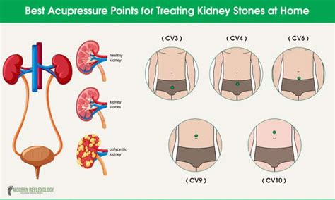 Outstanding Acupuncture Points For Treating Kidney Stones At Home