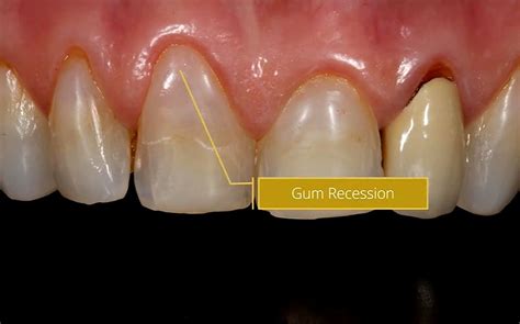 Gum Recession Causes And Treatment Dr Gurs Sehmi