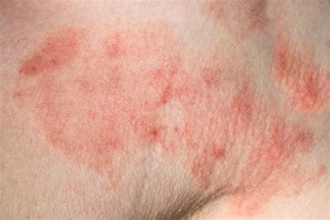 Lyme Disease Skin Rash Puzzles Doctors Leads To Misdiagnoses Daniel Cameron Md Mph