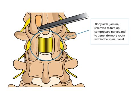 Minimally Invasive Spinal Decompression Laminectomy Dr Yu Chao Lee
