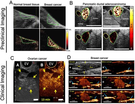 Seeing The Invisible—ultrasound Molecular Imaging Ultrasound In